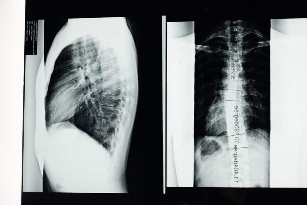 Spine X-rays